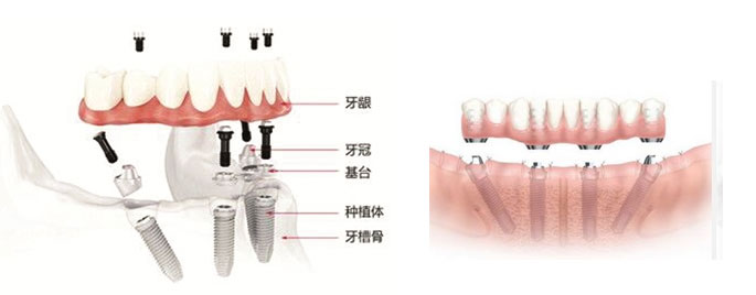 半口种植牙修复要多长时间