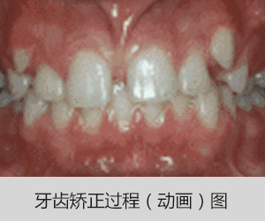 南京牙齿之间有缝隙怎么修补