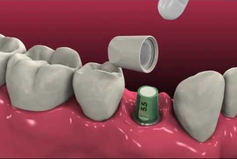 影响种植牙寿命的因素有哪些？