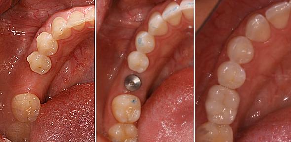 种植牙的寿命受哪些因素影响？