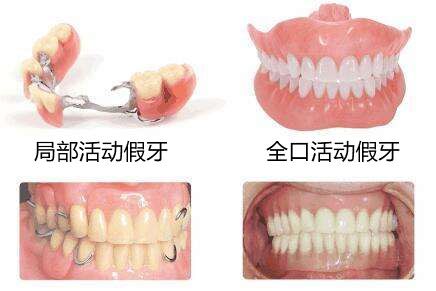 活动义齿的种类有哪些？