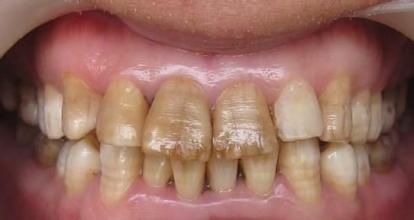 牙黄的原因有哪些？