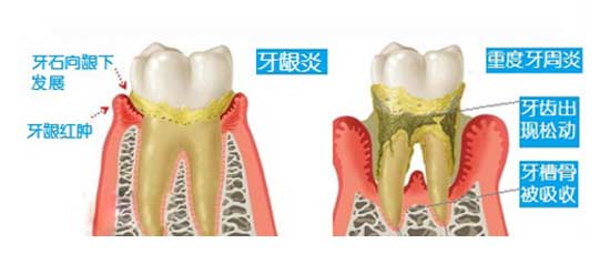 牙周炎有效的治疗方法